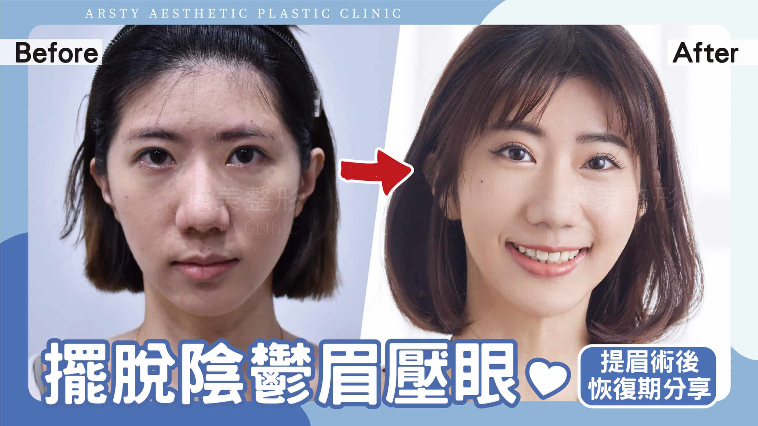 YouTube video cover - E220704_01 Eyebrow lift case - scaled-1