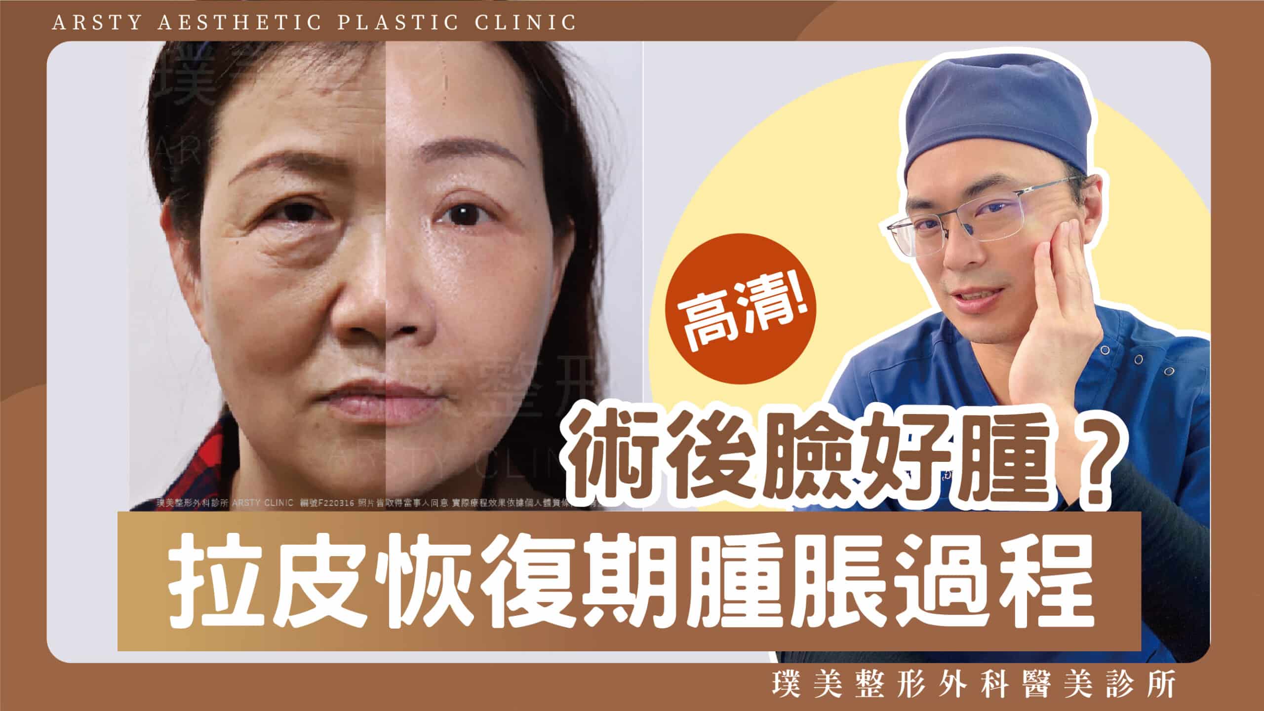 Arsty Clinic Video_Dr. Wei-Cheng Ching_11 Swelling Period After Face Lift - Scaled - 1