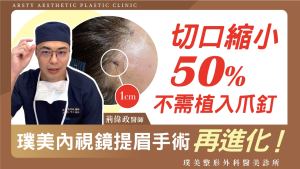 Arsty Clinic影片_荊偉政醫師_16內視鏡提眉縮小切口