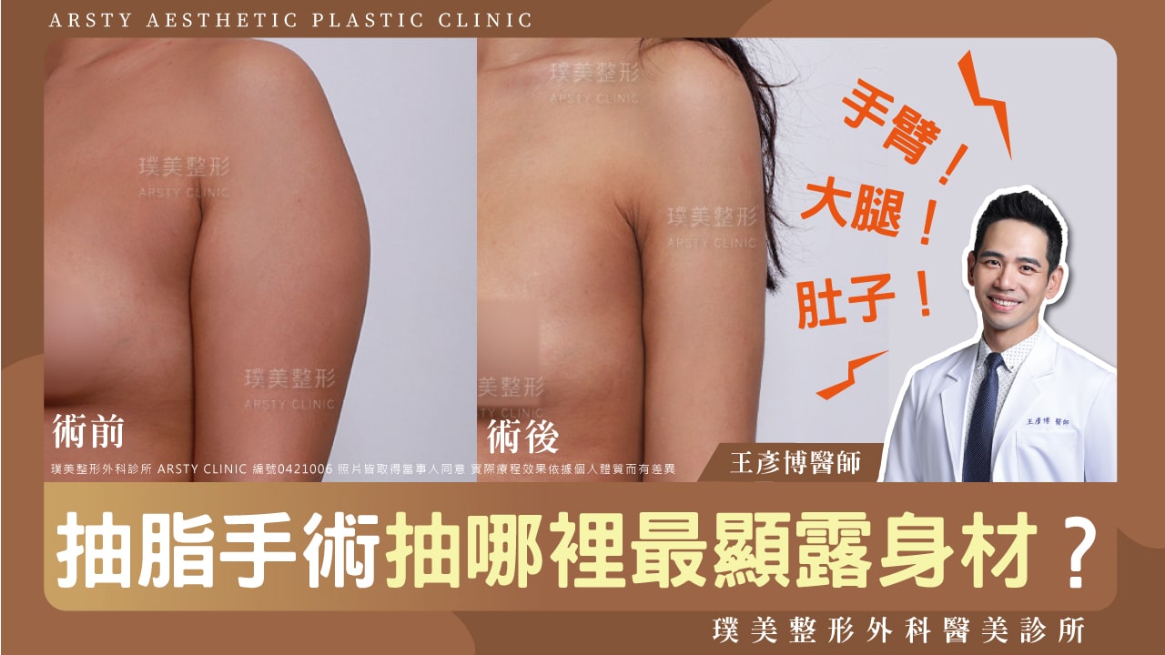 璞美影片_王彥博醫師封面2024_4抽脂手術抽哪裡最顯露身材