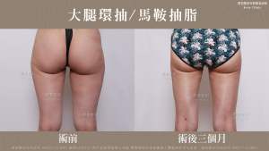 ★大腿環抽_馬鞍抽脂-C220731BA3M04-局