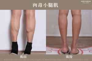 Botox Calf Muscles_F220130_01
