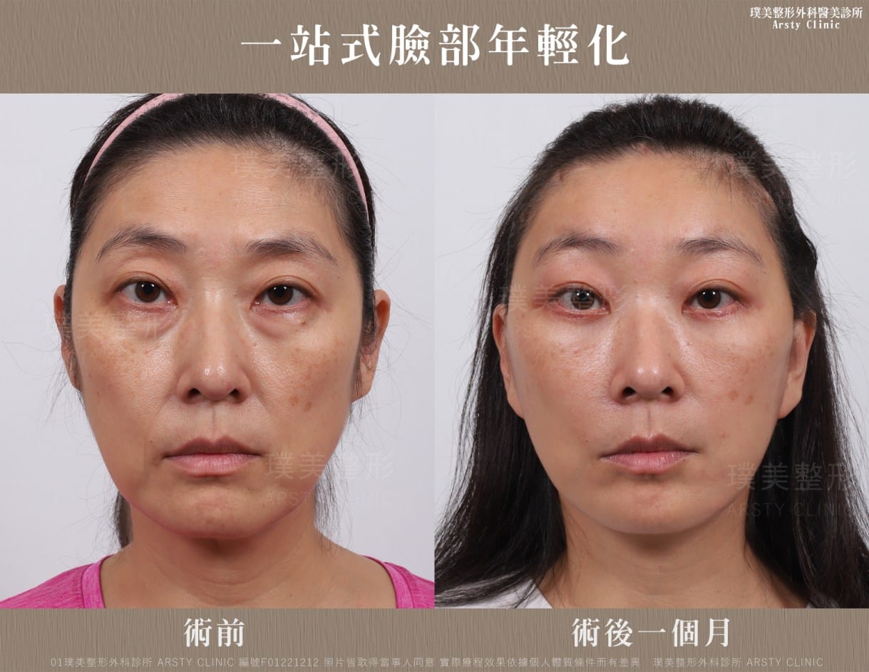 全臉拉皮手術推薦案例分享