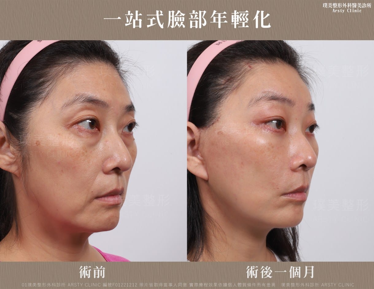 全臉拉皮手術推薦案例分享