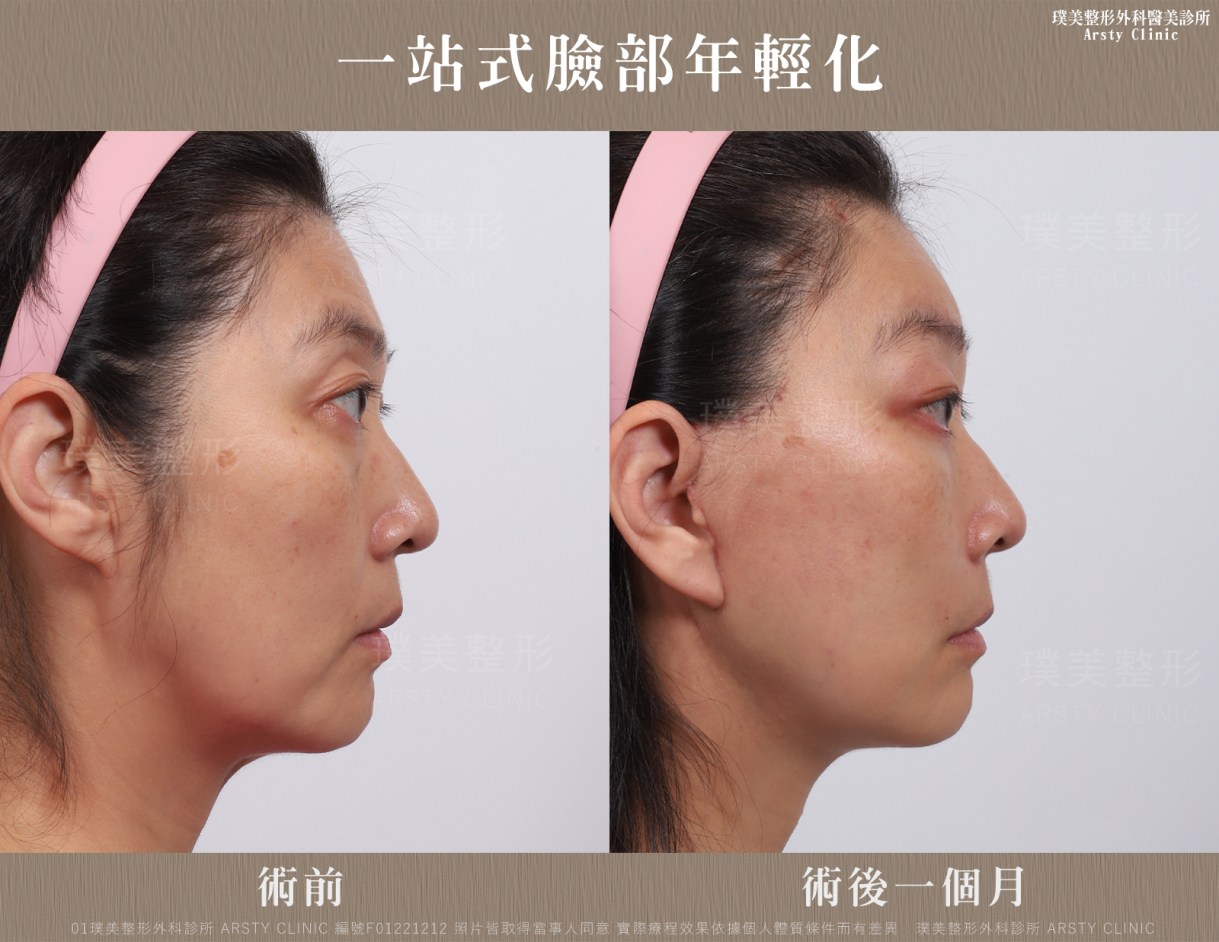全臉拉皮手術推薦案例分享
