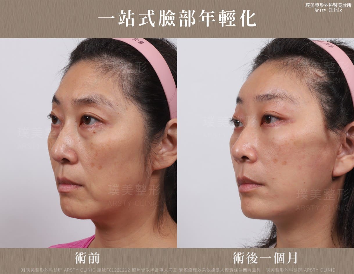全臉拉皮手術推薦案例分享