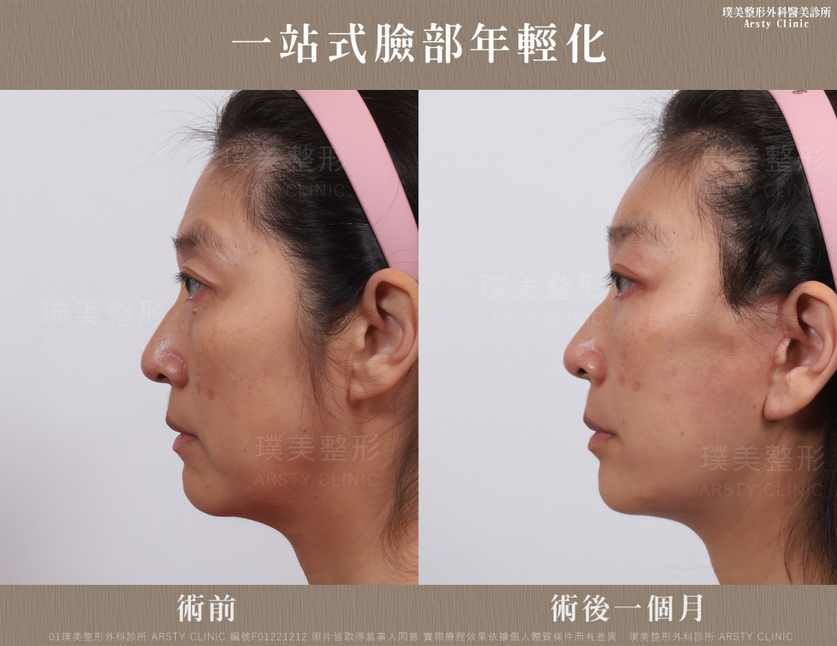 全臉拉皮手術推薦案例分享