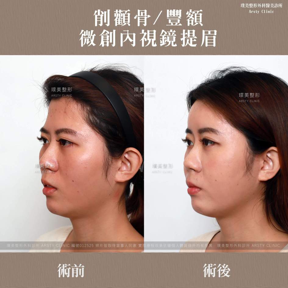 手術手順：頬骨縮小術＋内視鏡下眉リフト