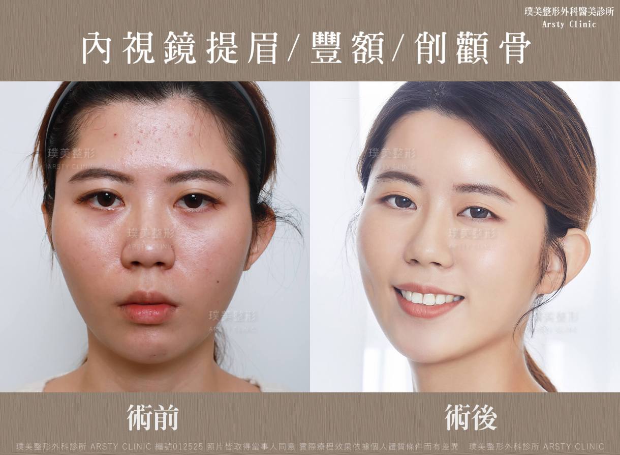 手術手順：頬骨縮小術＋内視鏡下眉リフト