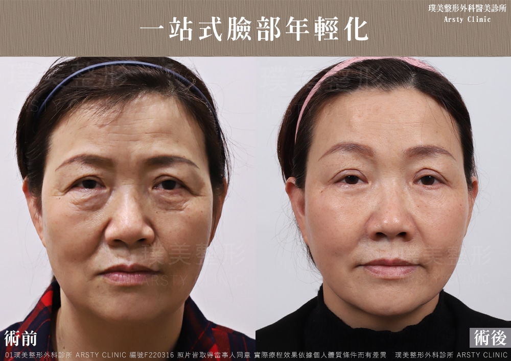 内視鏡下眉リフト手術とは何ですか？