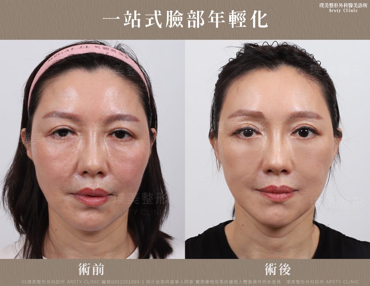 内視鏡下眉リフト手術とは何ですか？