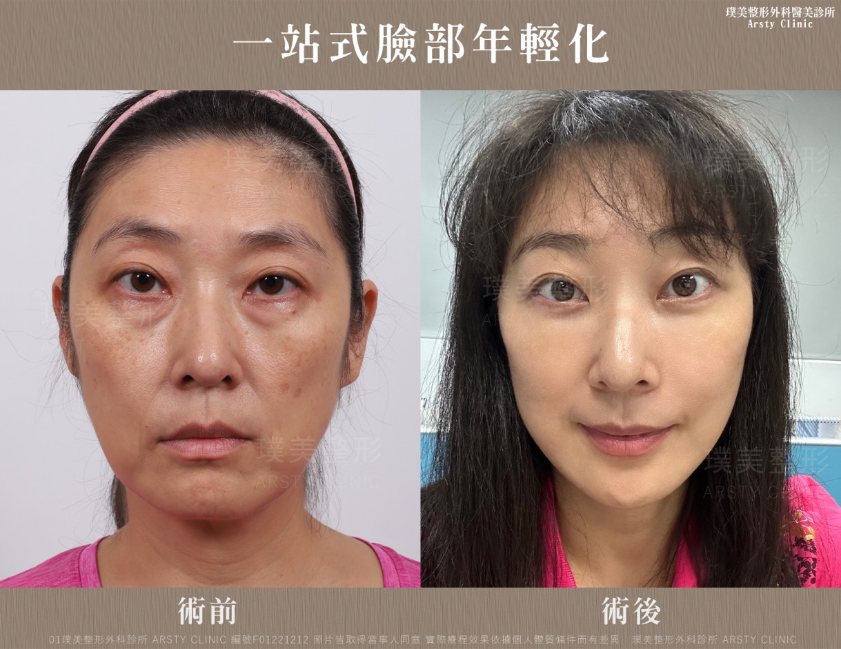 個別治療プラン：内視鏡下眉リフトと組み合わせることで、より優れた若返り効果が得られる手術はどれですか？