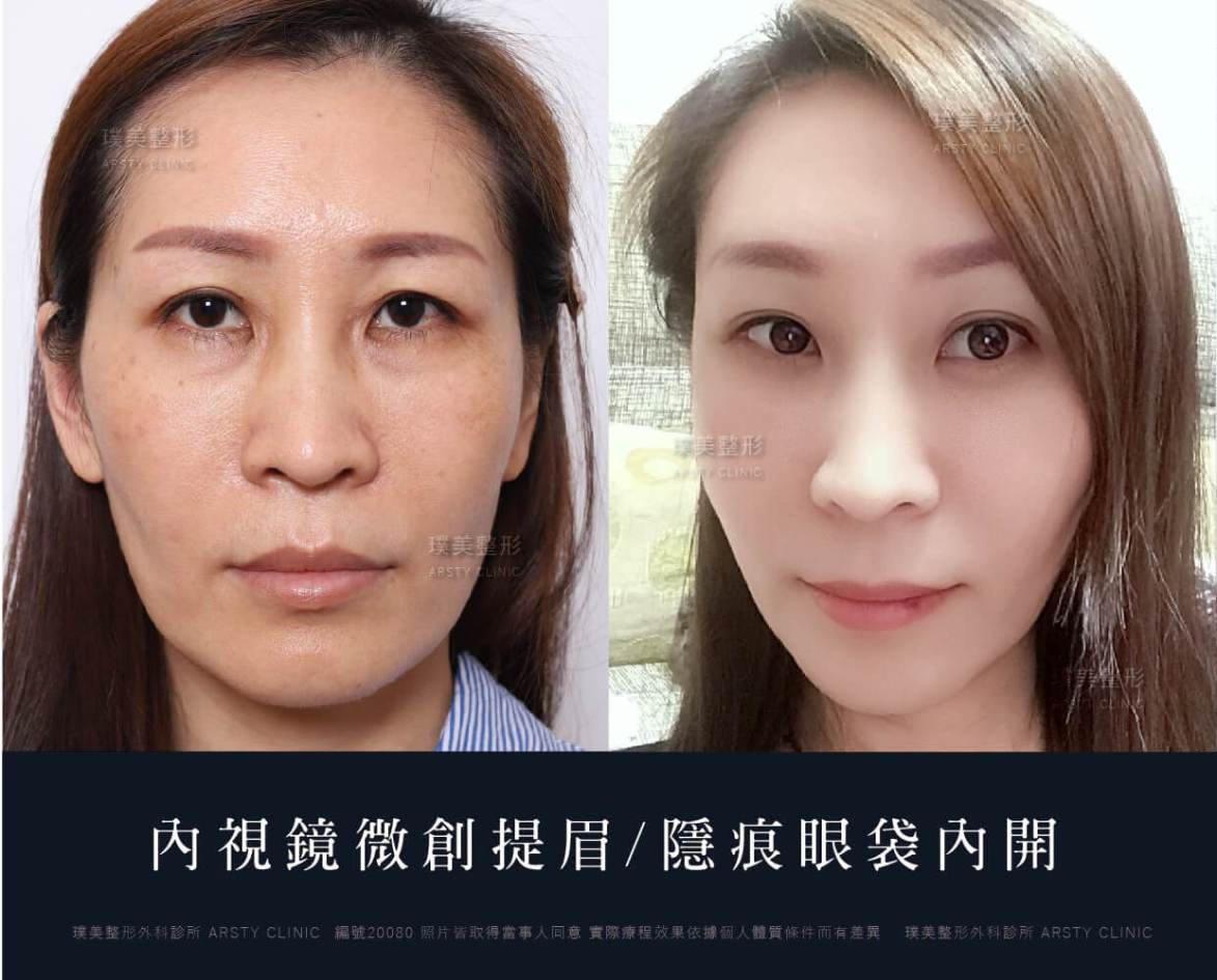 個別治療プラン：内視鏡下眉リフトと組み合わせることで、より優れた若返り効果が得られる手術はどれですか？