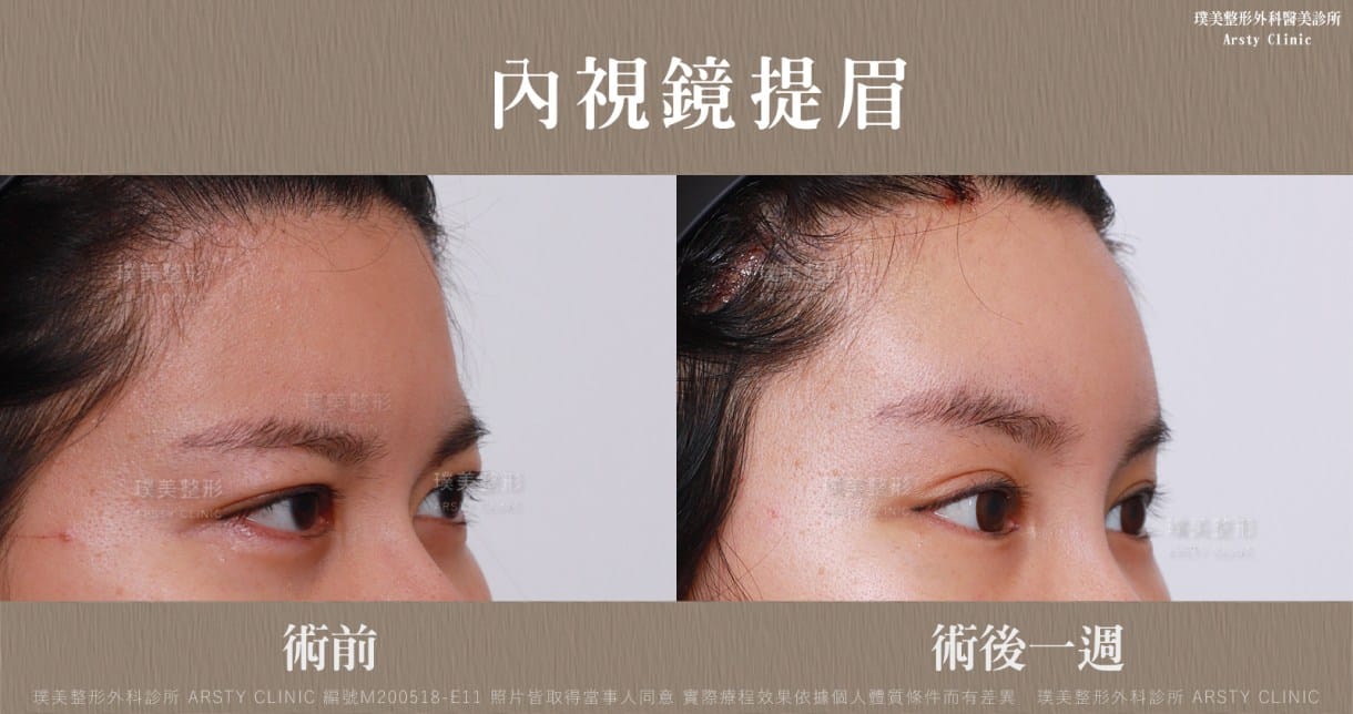 内視鏡下眉リフト症例共有