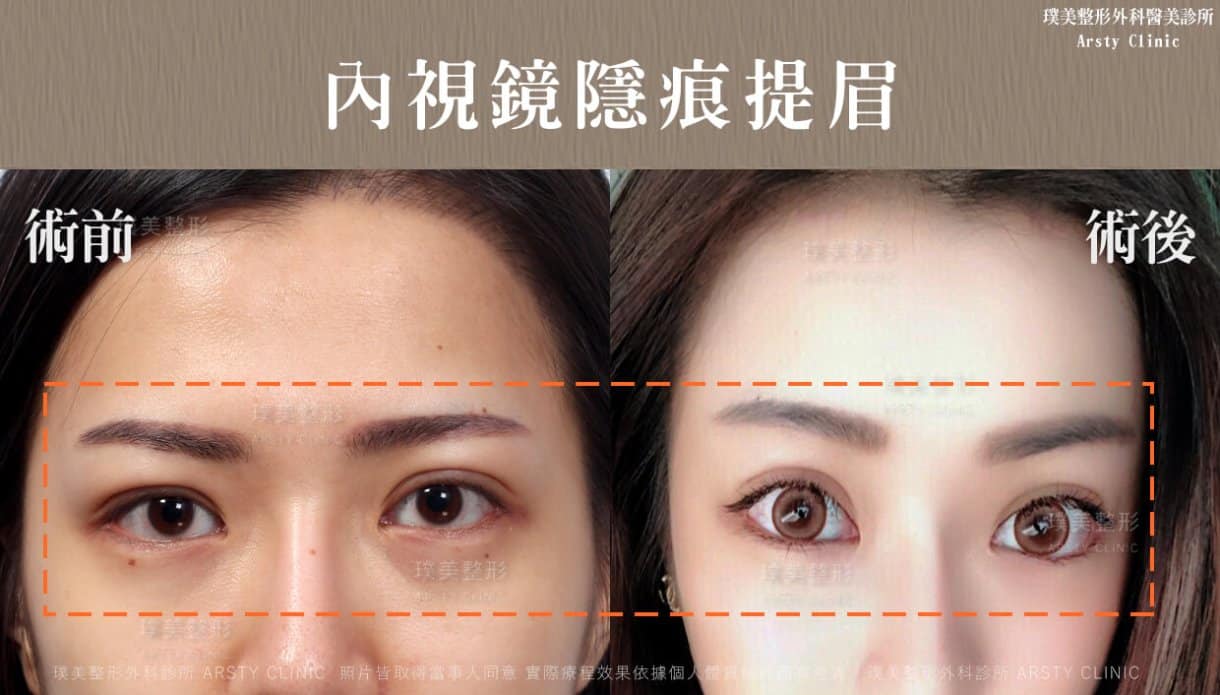 内視鏡下眉リフト症例共有