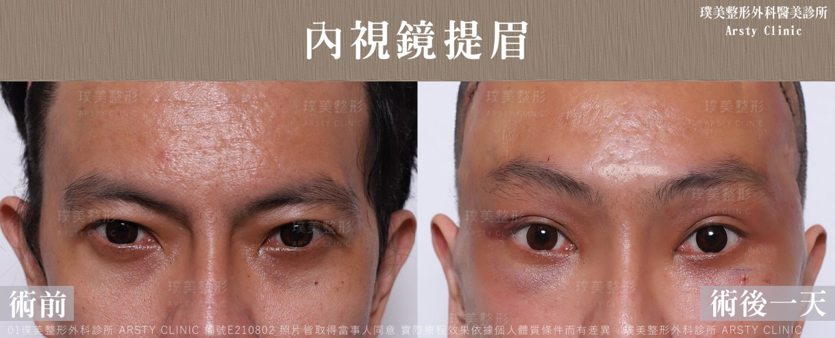 内視鏡下眉リフト症例共有