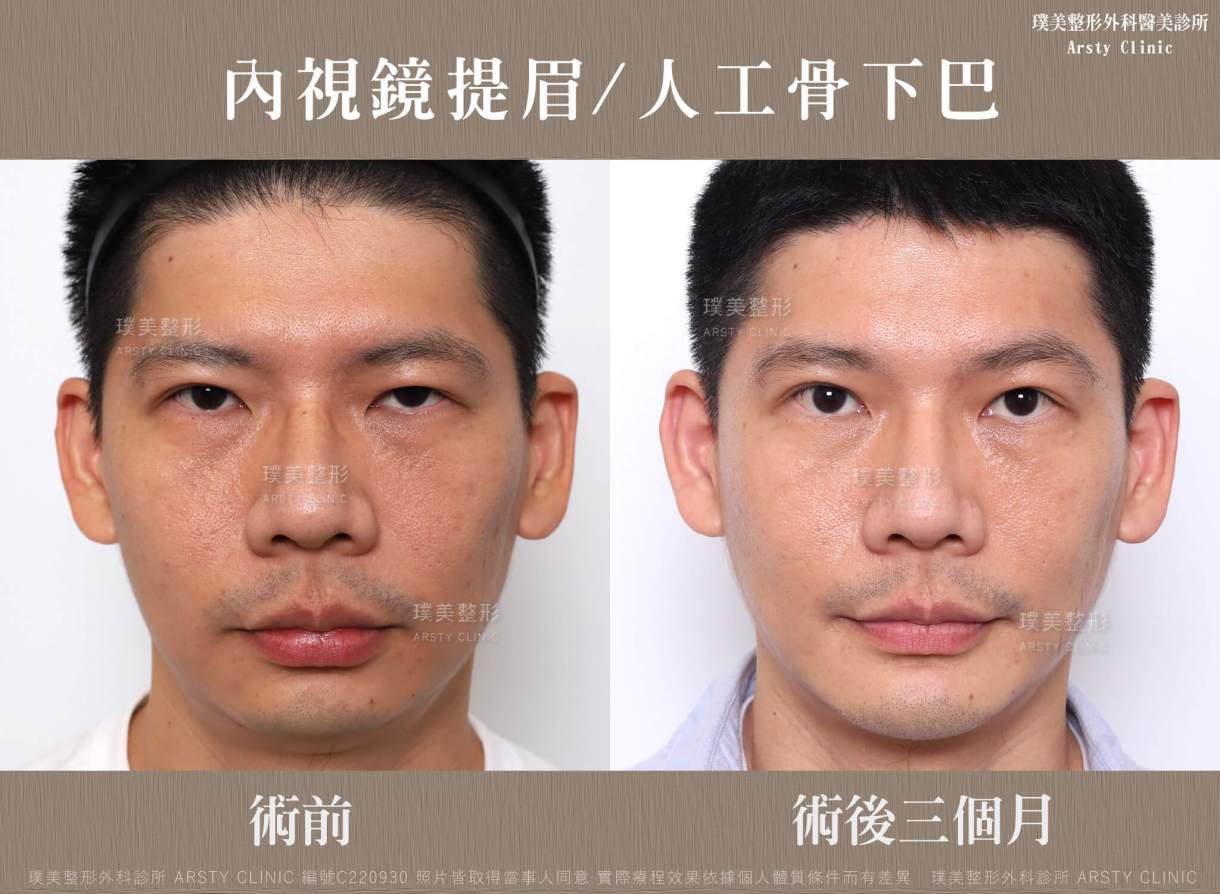 内視鏡下眉リフト症例共有