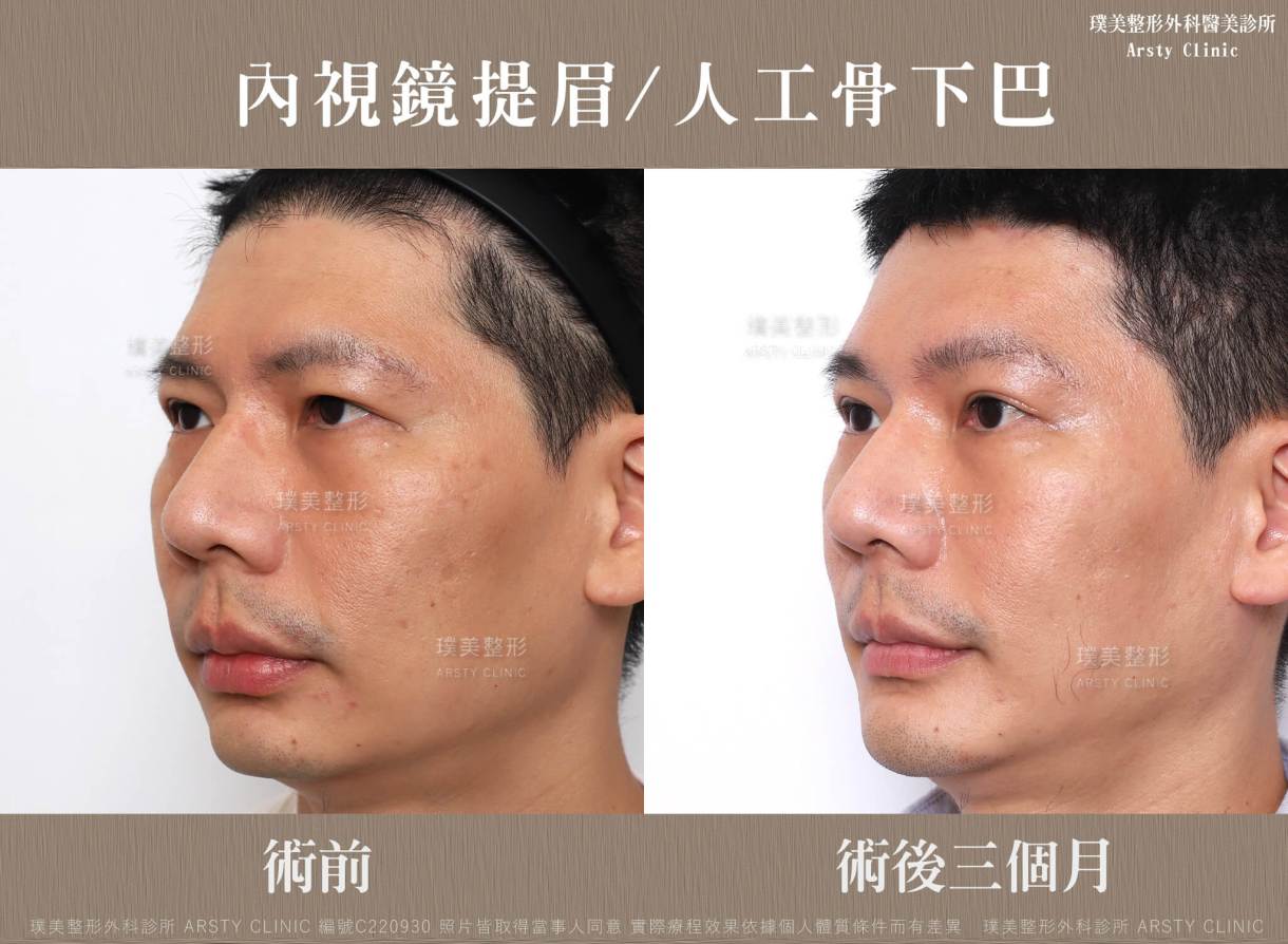 内視鏡下眉リフト症例共有