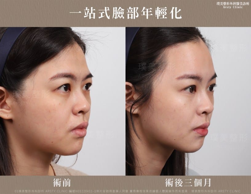 2026年最新更全面更安全的拉皮技術