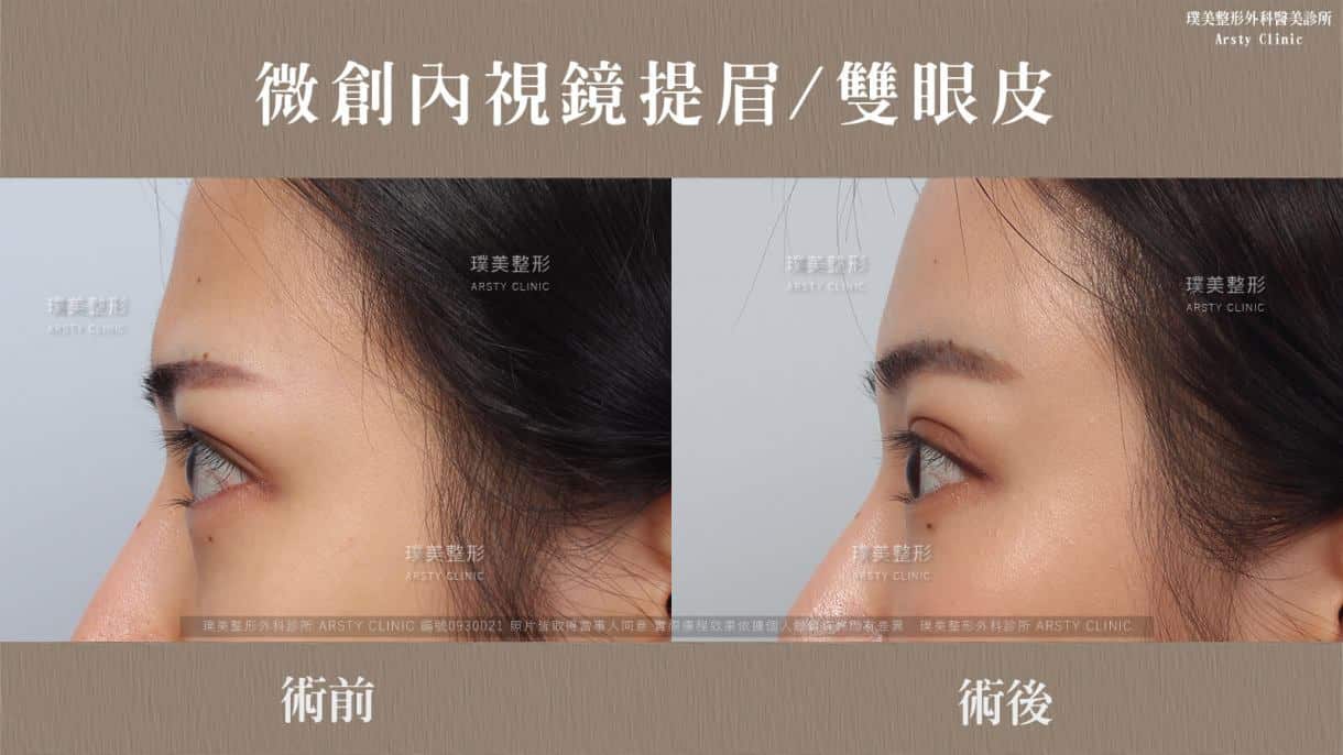 全臉拉皮手術推薦案例分享