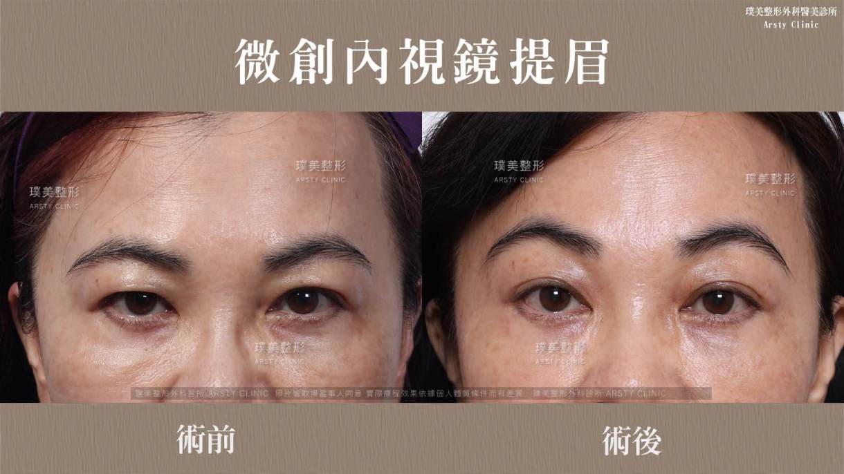 全臉拉皮手術推薦案例分享