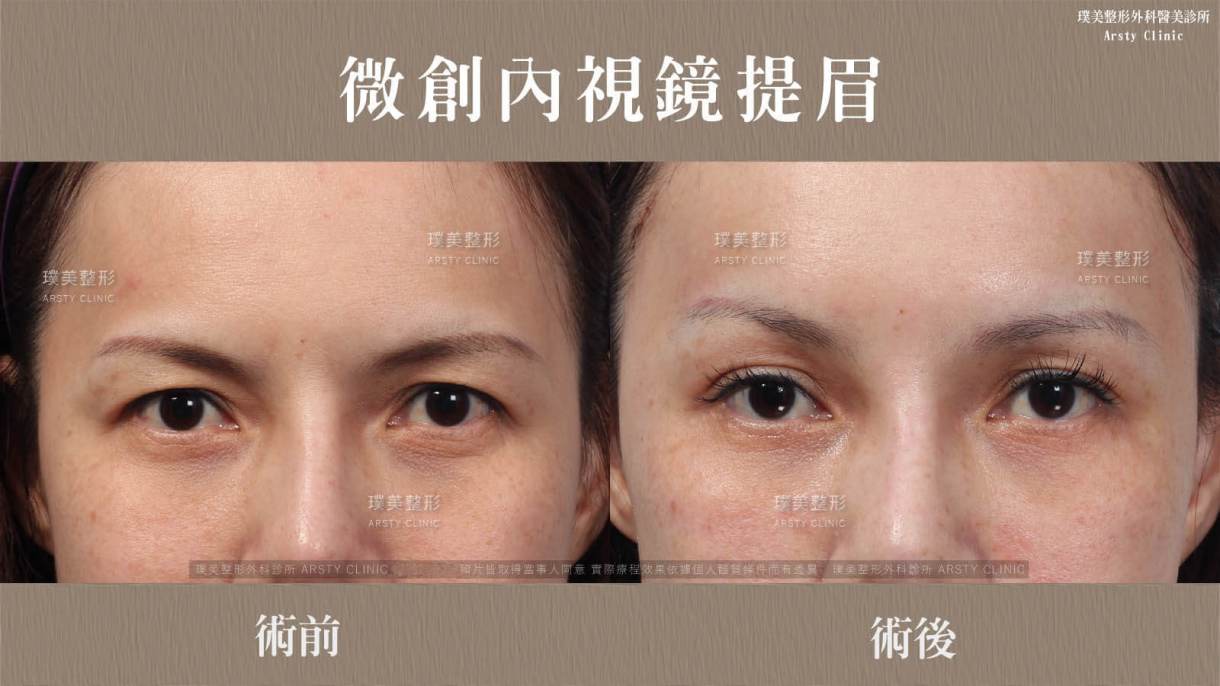 全臉拉皮手術推薦案例分享