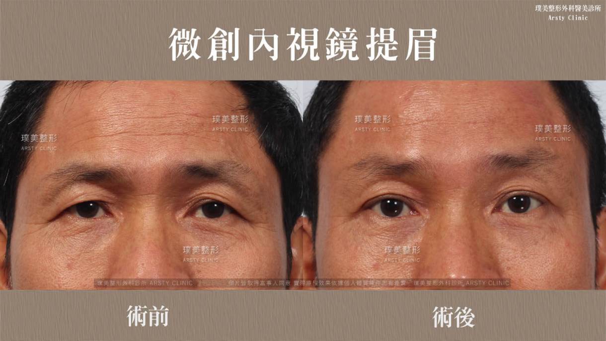 全臉拉皮手術推薦案例分享