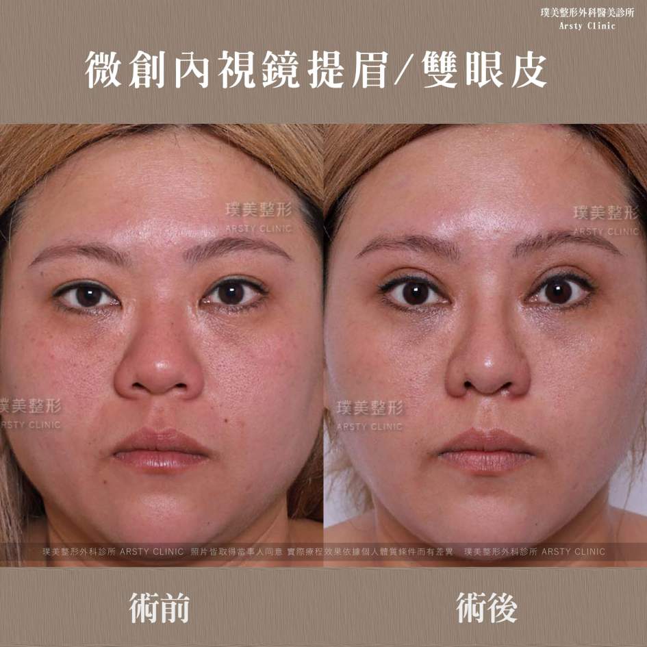 全臉拉皮手術推薦案例分享