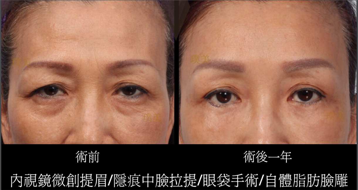 全臉拉皮手術推薦案例分享