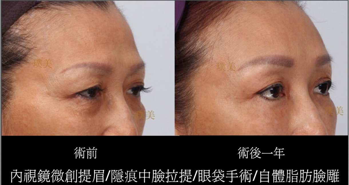 全臉拉皮手術推薦案例分享