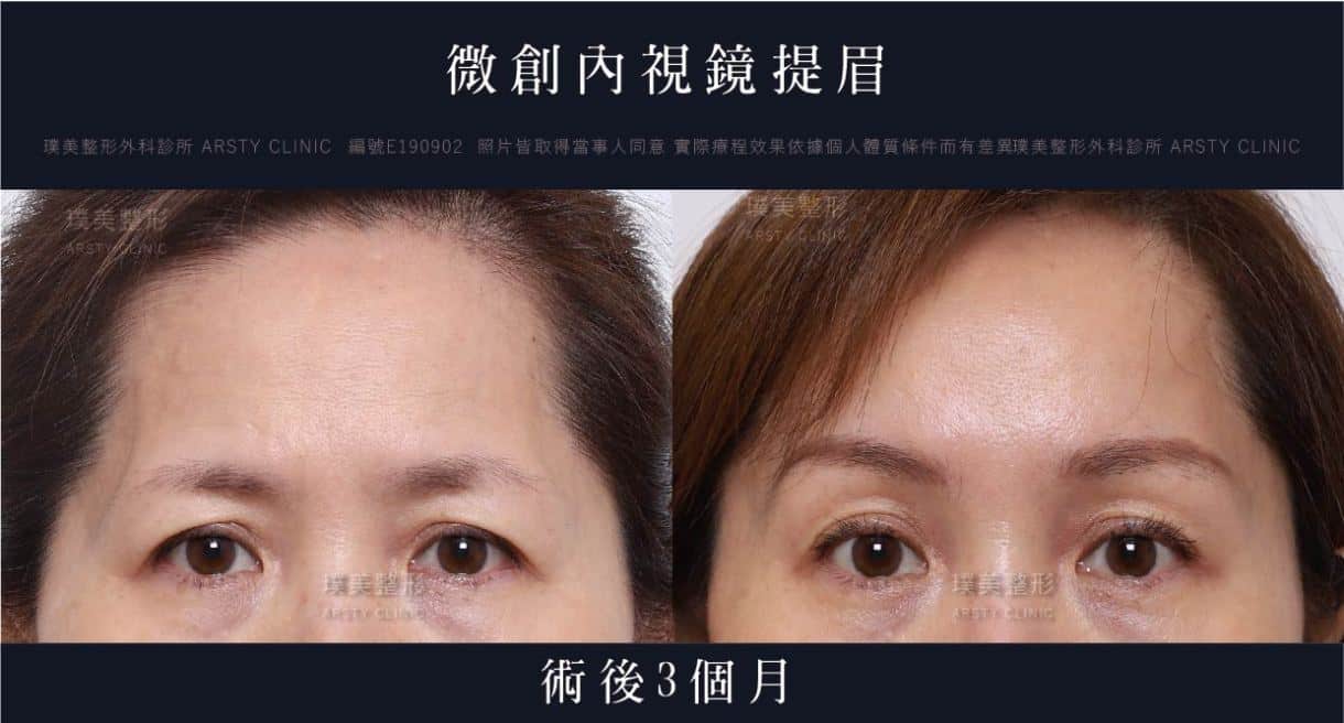 全臉拉皮手術推薦案例分享