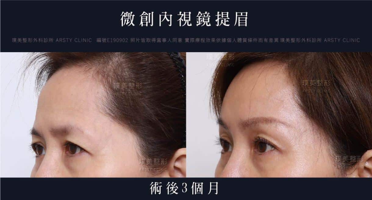 全臉拉皮手術推薦案例分享