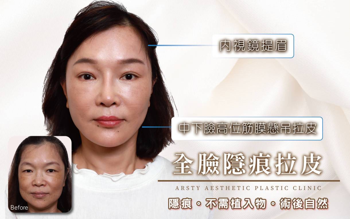 ▍全臉拉皮手術種類：