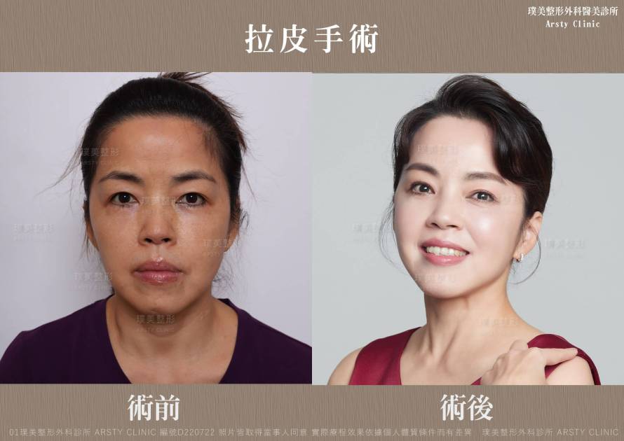 ▍全臉拉皮手術種類：