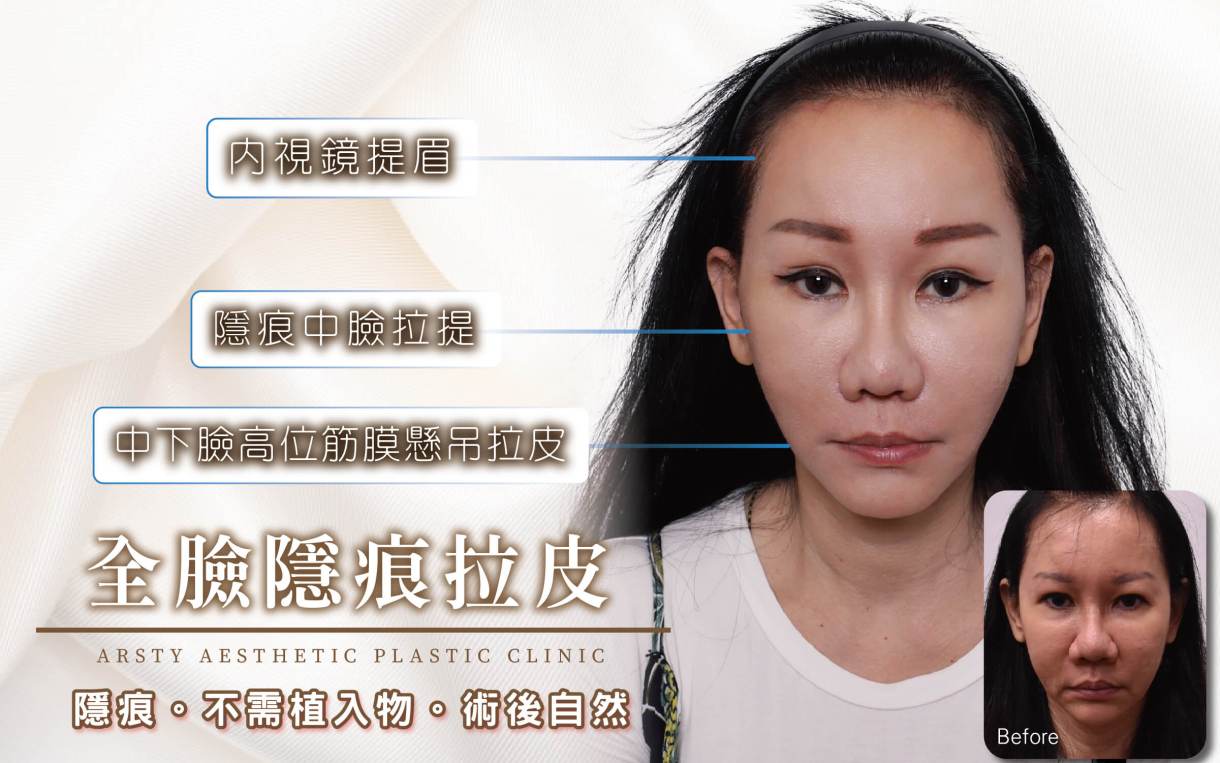 ▍全臉拉皮手術種類：