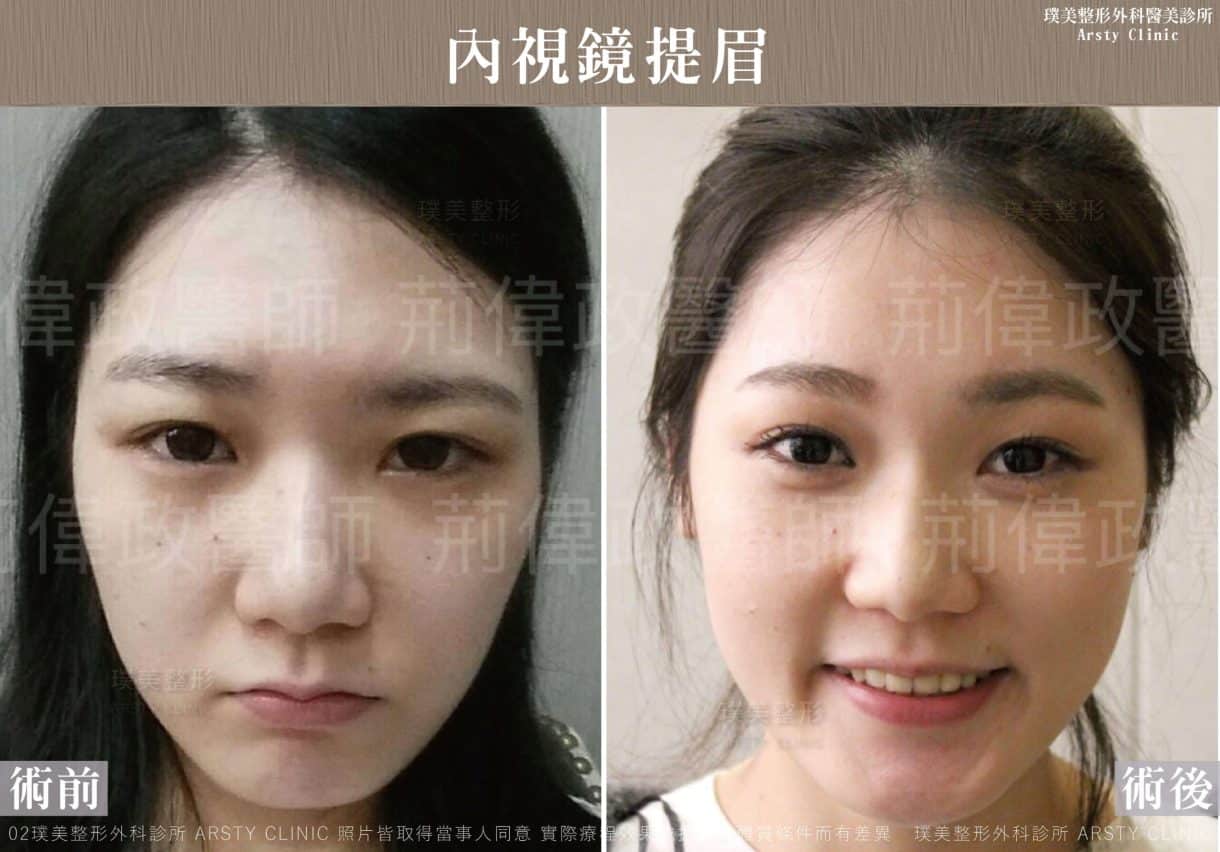 ▍全臉拉皮手術種類：