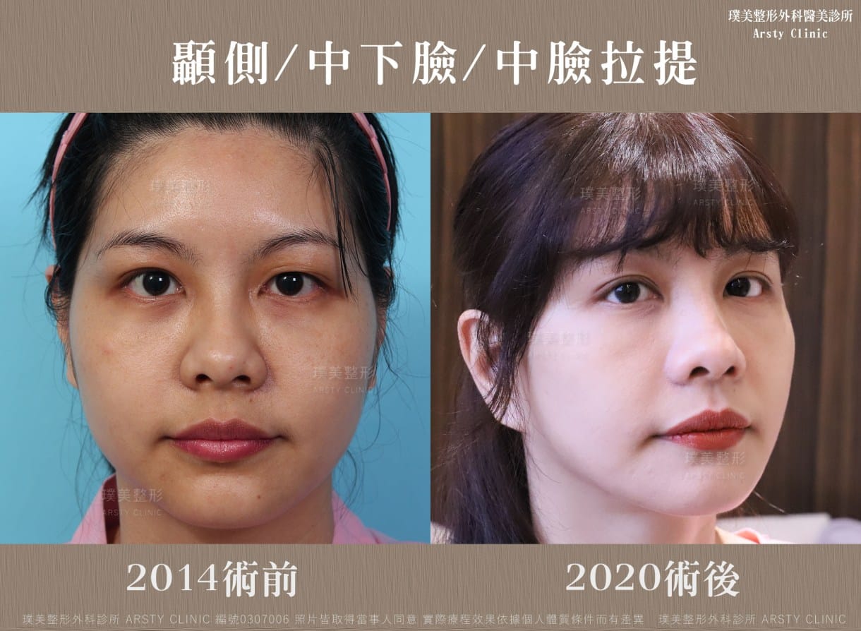 ▍全臉拉皮手術種類：