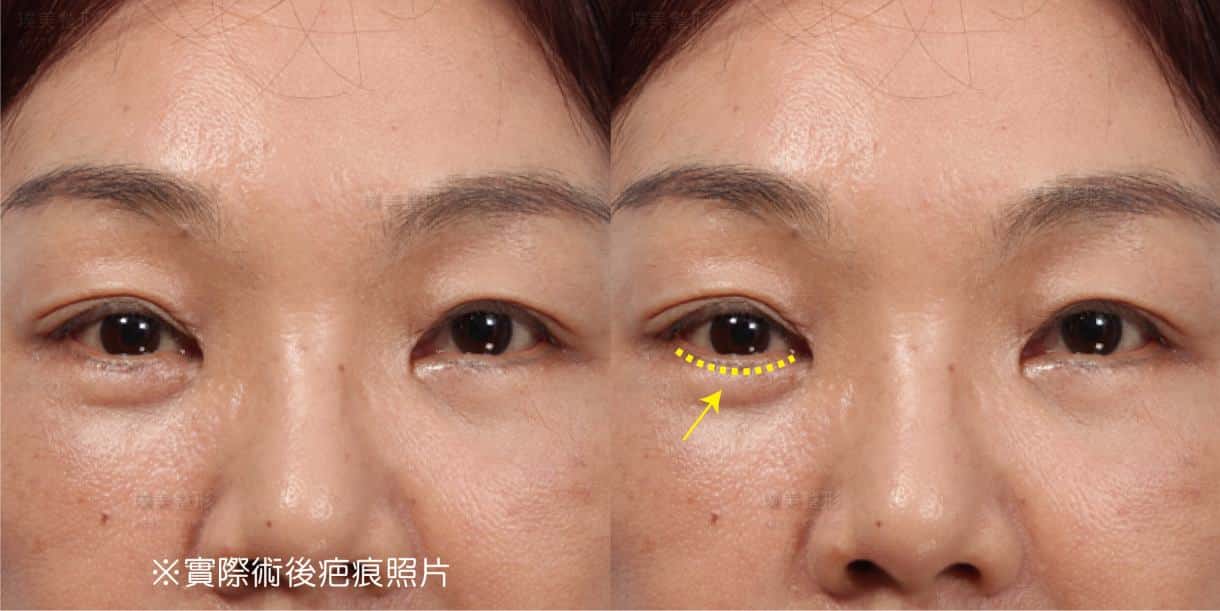▍全臉拉皮手術種類：