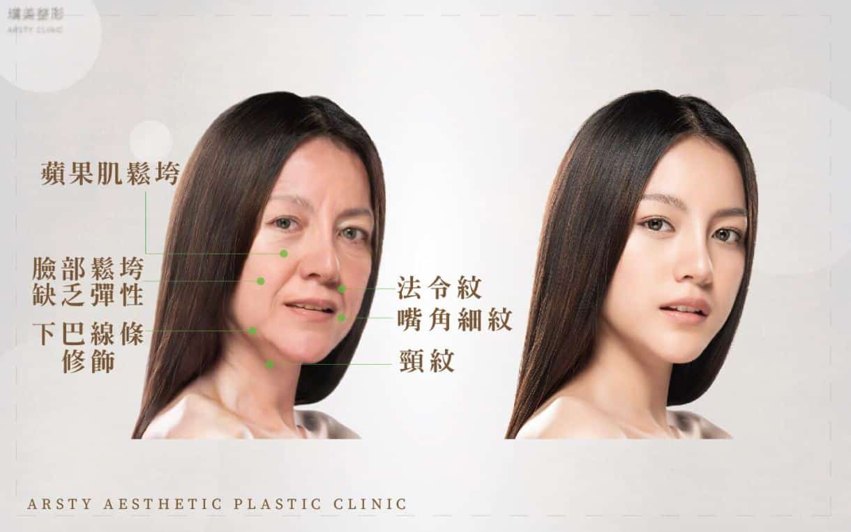 ▍全臉拉皮手術種類：