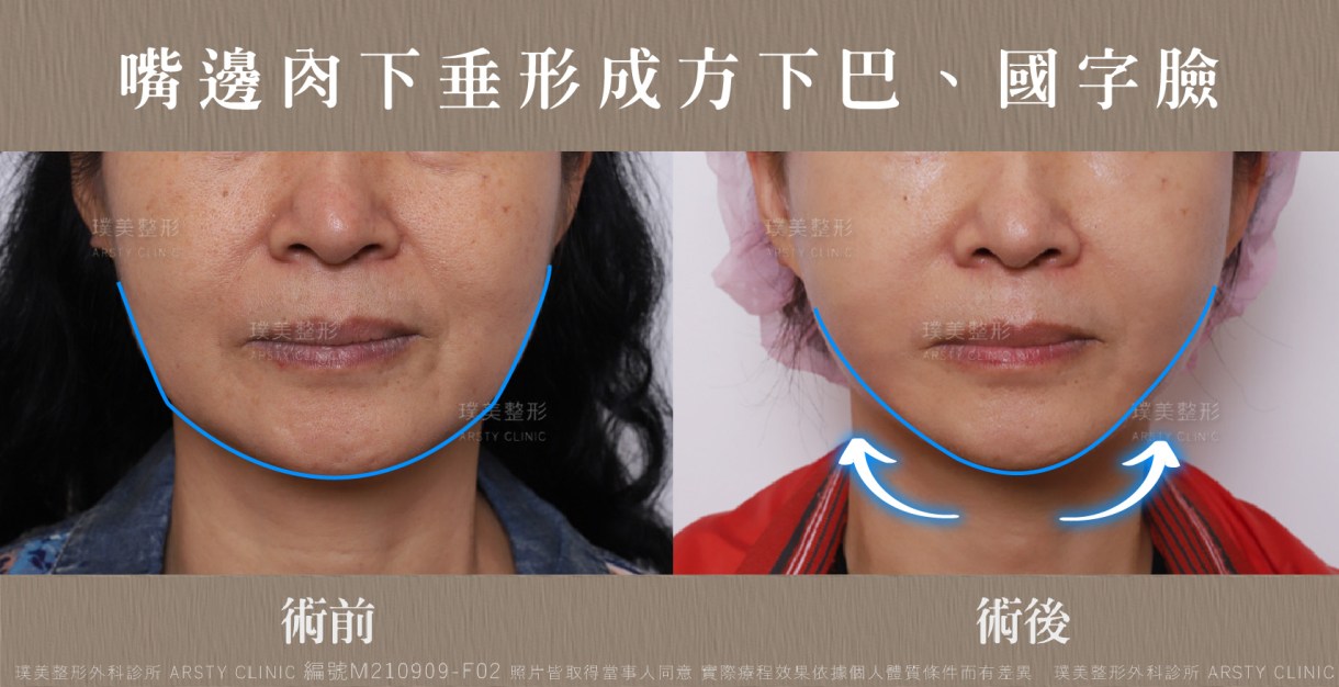 ▍全臉拉皮手術種類：