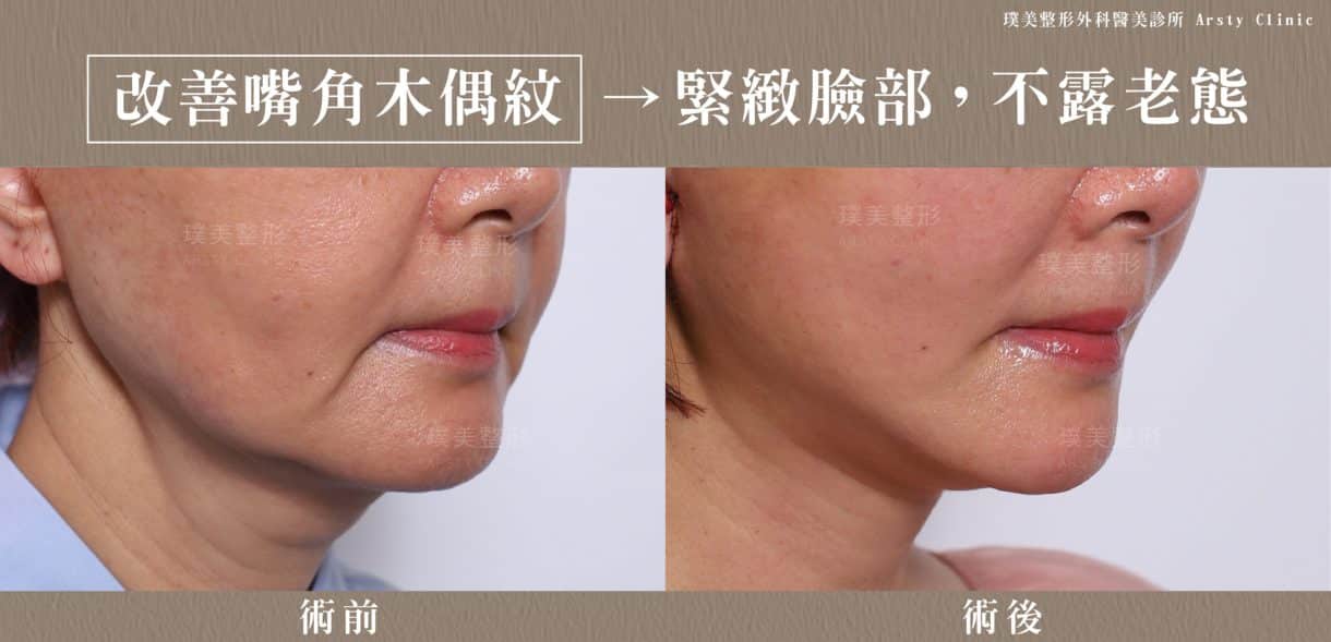 ▍全臉拉皮手術種類：