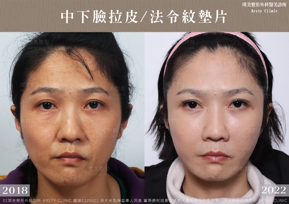 ▍全臉拉皮手術種類：
