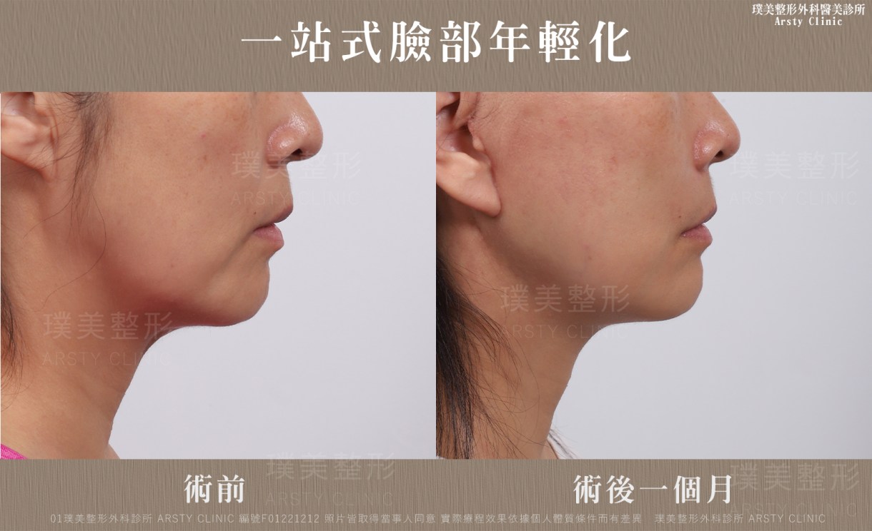 ▍全臉拉皮手術種類：