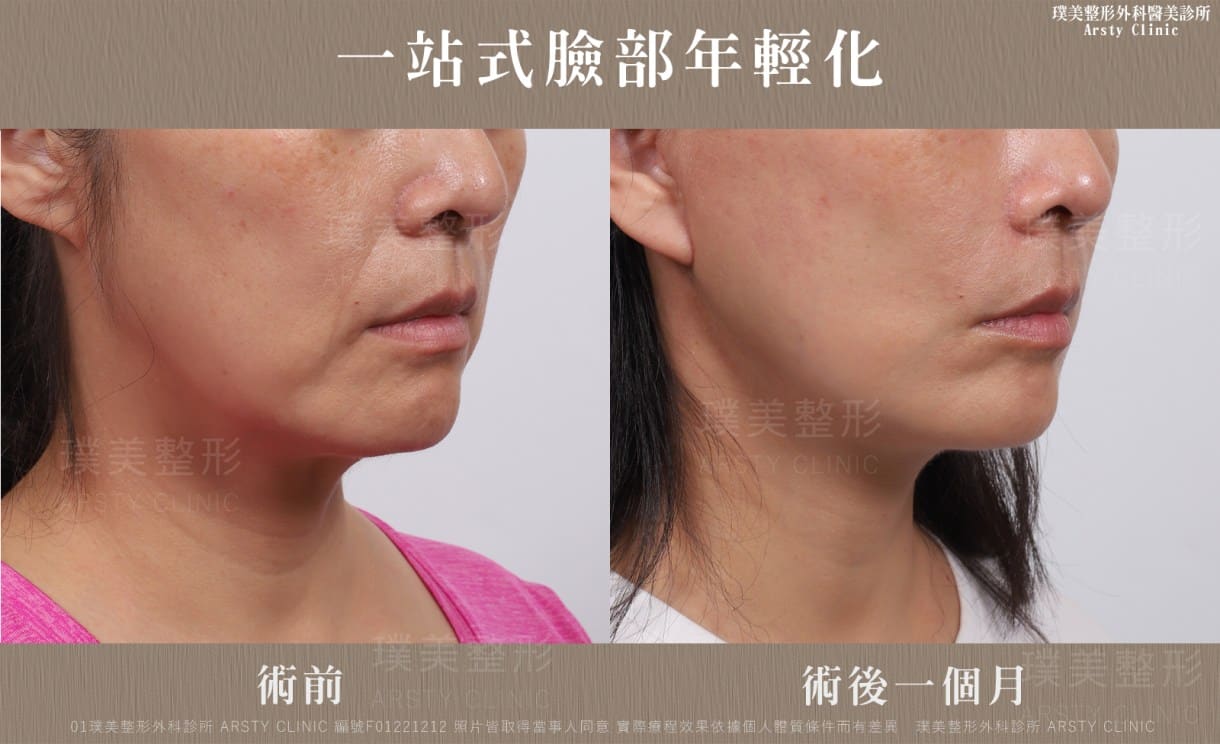 ▍全臉拉皮手術種類：