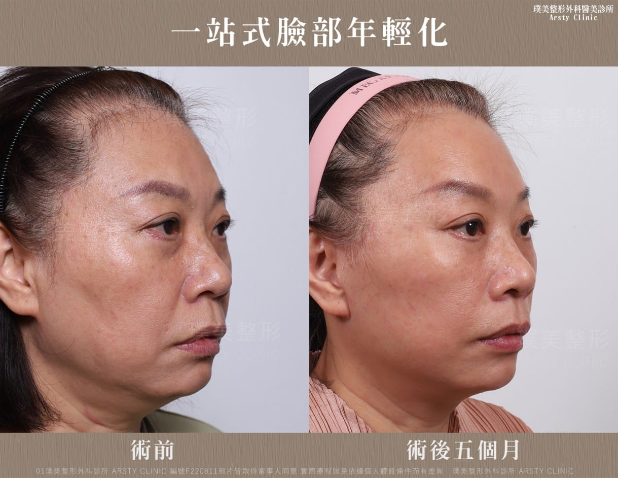 ▍全臉拉皮手術種類：