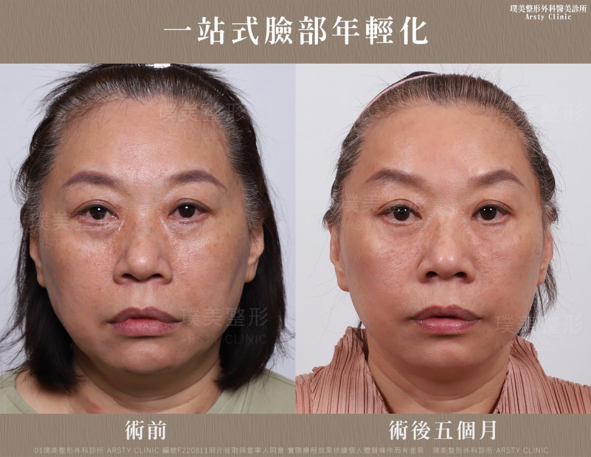 ▍全臉拉皮手術種類：