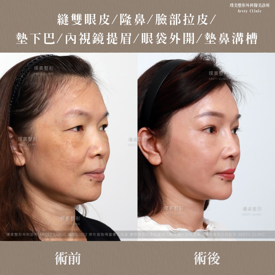 全臉拉皮手術推薦案例分享