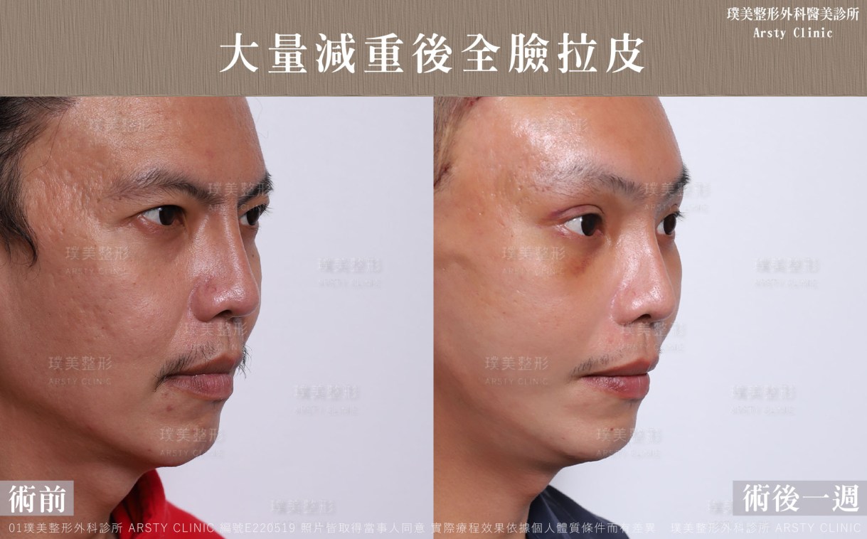全臉拉皮手術推薦案例分享