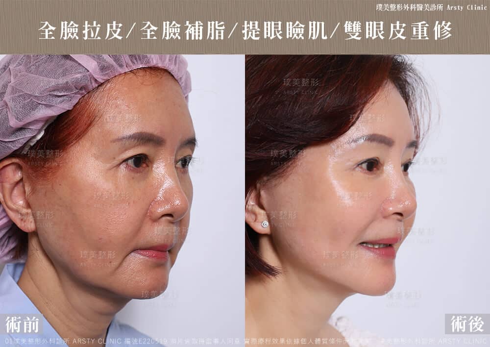 全臉拉皮手術推薦案例分享