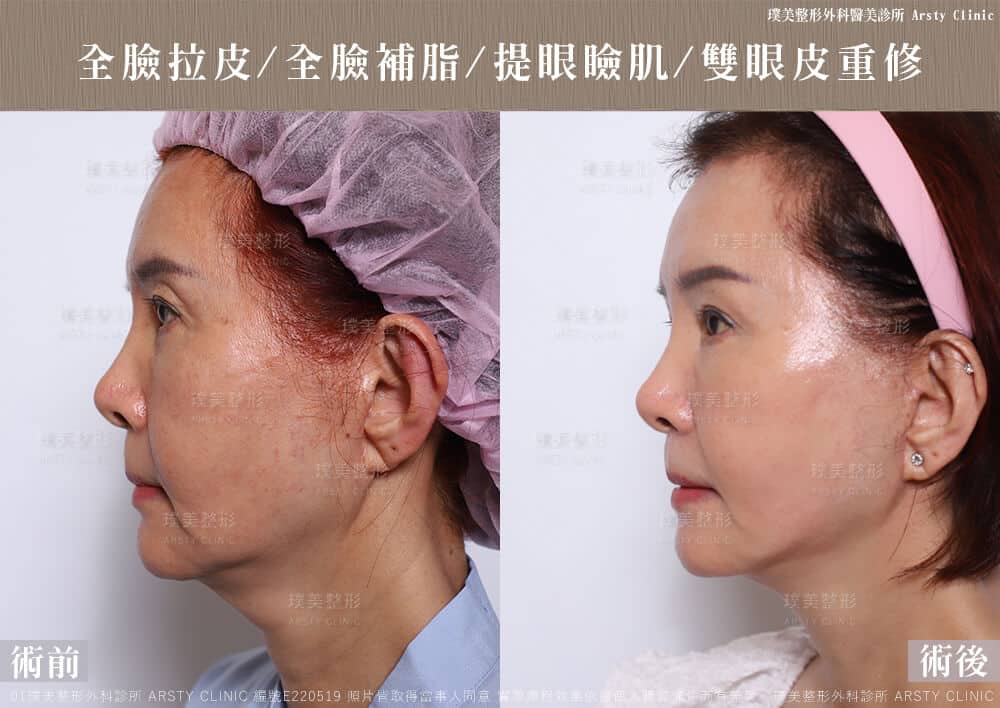 全臉拉皮手術推薦案例分享
